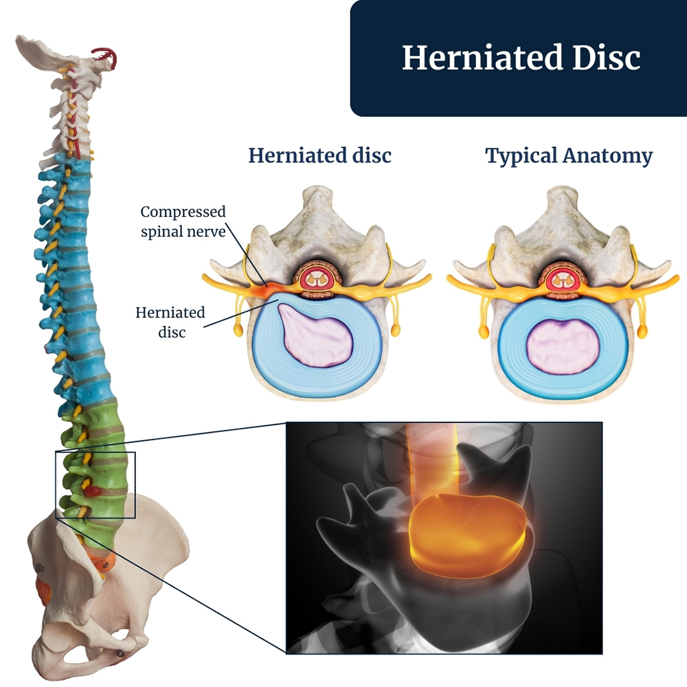Best Herniated Disc Specialist Surgeon Irving, TX