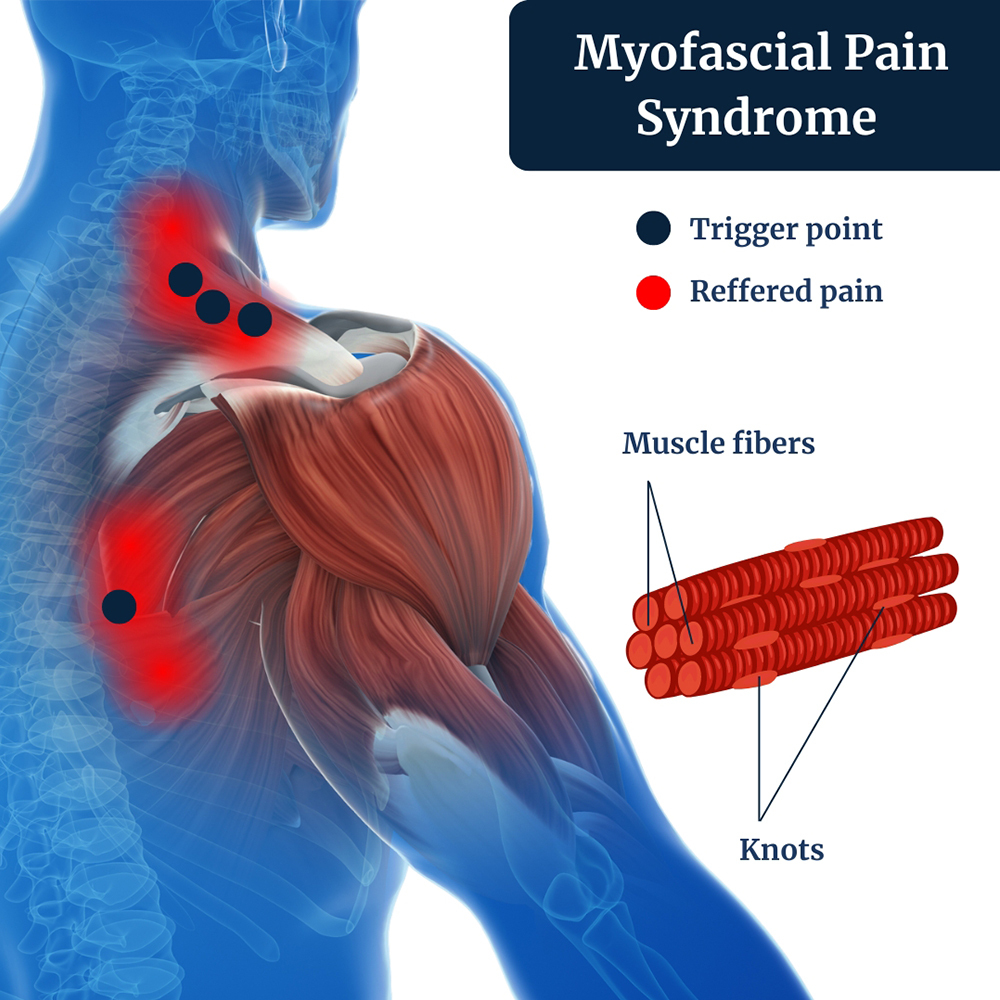 Myofascial Pain Syndrome Irving, TX | Muscle Pain Treatment in Dallas, TX