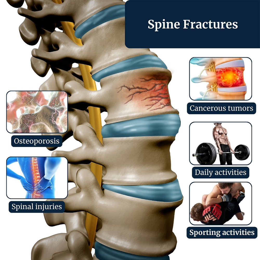 Compression Fracture Treatment Irving, TX | Gottlieb Spine